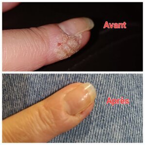 Verrues doigts avant et après séance de magnétisme