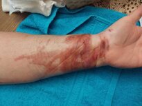 Brûlure avant bras après séance