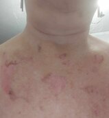 Brûlure avant séance