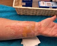 Brulure avant bras avant séance